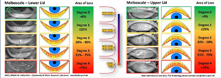 diagram of meibomian gland dysfunction severity